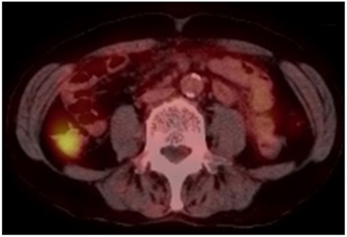 Figure 4 18F-FDG-PET/CT finding.