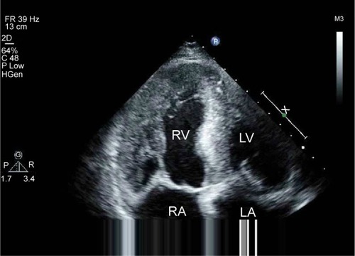 Figure 2 A four-chamber apical view echocardiogram showing biatrial dilatation, valve thickening, thick ventricular walls (left ventricular wall is 15 mm and interventricular septum is 19 mm), and interventricular septum with speckled appearance, which suggests amyloid infiltrate.