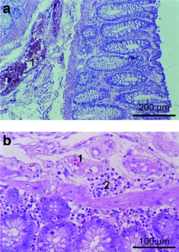 Figure 15 Plethora of microcapillaries A) and areas of cell infiltrations in the submucous layer of the submucosa B) of IBS patient (1 – microcapillaries with venous stasis phenomena, 2 – plasmocytic infiltrations, hematoxylin-eosin staining). Bars: a = 200 μm, b = 100 μm.