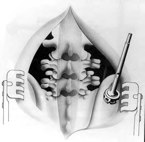 Figure 4:2 Schematic drawing of posterolateral uninstrumented fusion after decortication but before bone harvesting with a reamer.