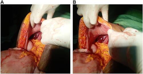 Figure 1 (A and B) intra-operative finding of Spontaneously Ruptured Sub-capsular Liver Hematoma.