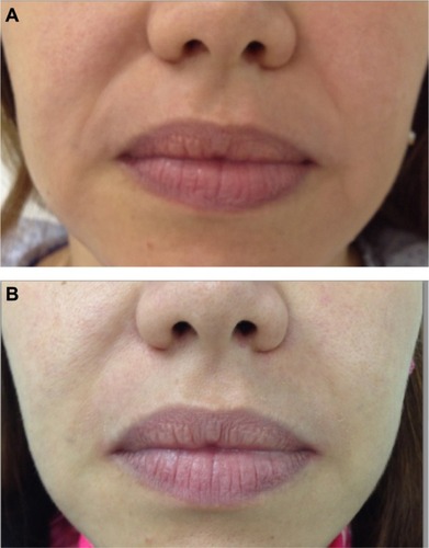 Figure 2 Patient 1 before (A) and after (B) Stylage® treatment.