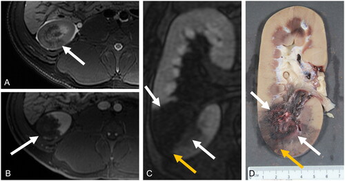Figure 3. MRI and gross pathology images of a histotripsy treatment (white arrow) in a porcine kidney. A) Axial T2-weighted fat-saturated MRI following histotripsy of a healthy swine kidney. B) Axial T1 weighted MRI with IV contrast (gadobenate dimeglumine) in the corticomedullary phase after treatment (white arrow). C) Coronal MRI with contrast 13 min after administering IV contrast. Note the wedge-shaped perfusion defect (yellow arrow) extending peripheral to the treatment zone (white arrows), causing the treatment zone to appear larger. D) Corresponding gross image demonstrating the central area of treatment (white arrows) with adjacent perfusion deficit (yellow arrow).