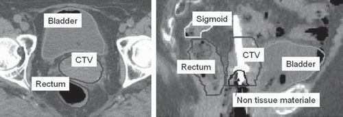 Figure 1. Delineation of volumes of interest in CT images in FIGO stage IIIB cervical cancer, second brachytherapy fraction. Left: Axial view. Right: Sagittal view.