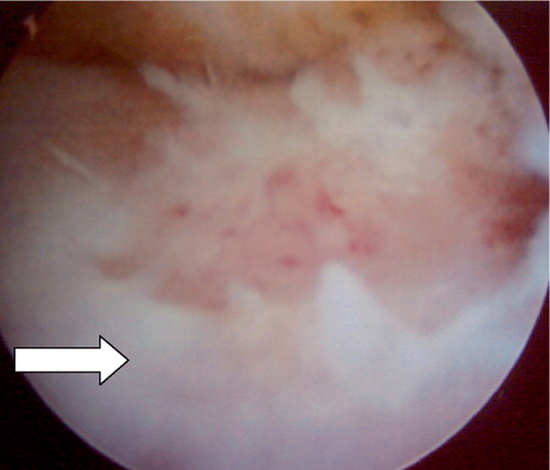 Figure 3. Case 1. Intraoperative view showing an elevated synovial lining (indicated by an arrow) and localized synovitis over the talar lesion.