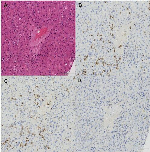 Figure 2 Results of liver biopsy. (A) Histopathology of the liver shows focal necrosis in the liver parenchyma and lymphocytic infiltration around the central vein. (B) Many CD3 positive lymphocytes and (C) CD8 positive lymphocytes are present. (D) Few CD20 positive lymphocytes were present.