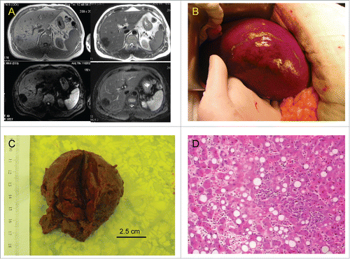 Figure 2. Hepatic adenoma of the brother. (A) Magnetic Resonance imaging; clockwise from upper-left: T1-weighted image, T2-weighted image, fat suppressed image, diffusion weighted image. (B) In situ hepatic adenoma. (C) View of resected hepatic adenoma. (D) Histology of resected hepatic adenoma.