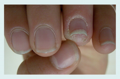 Figure 11. Parakeratosis pustulosa.A single fingernail showing mild subungual hyperkeratosis and onycholysis, associated with periungual scaling. Note traumatic punctate leukonychia of the fifth fingernail.