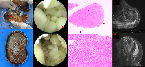 Figure 2 Macroscopic view and histopathology of rice body formation and postoperative images. (A): Rice bodies and yellow bursa fluid were removed after the channel was placed. (B) Yellow bursa fluid and rice bodies of various sizes (approximately a few millimeters). (C and D): Arthroscopic observation of rice bodies of different sizes and smooth surfaces. (E and F): Histopathology suggests that the rice body is mainly composed of fibrin material with inflammatory cells. (G and H): Postoperative MRI showed complete removal of rice bodies.