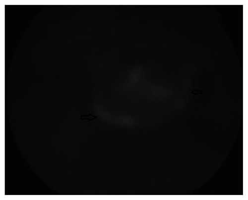 Figure 5 Late fluorescein transit of the left eye at presentation.