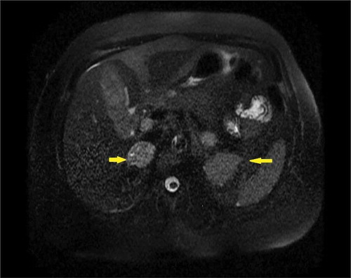Figure 1. MRI abdomen/pelvis without contrast demonstrating bilateral solid slightly heterogeneous adrenal gland masses (yellow arrows).