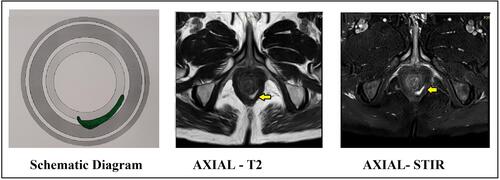 Figure 4 Abscess in left intersphincteric space from 4 to 6 o’clock. (external sphincter muscle can be seen lateral to the abscess). Abscess indicated by yellow arrows. Left panel: Schematic diagram. Middle panel: MRI axial section T-2 sequence. Right panel: MRI axial section STIR sequence.