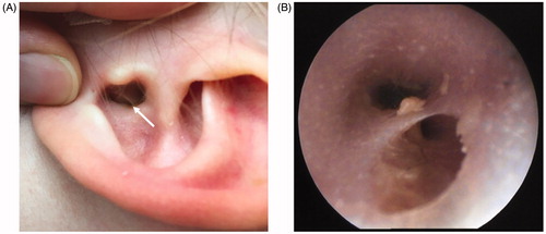 Figure 1. Preoperative images. (A) Preoperative picture, the with arrow points at the sinus of the cartilaginous auditory canal. (B) Preoperative otoscopic image.