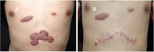Figure 3 Example of keloid in epigastric region treated with excision followed by intralesional 5-FU and betamethasone. (A) Before treatment, (B) at 6 months of follow-up.
