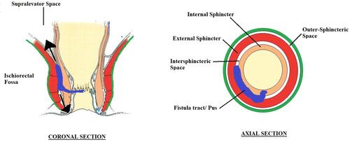 Figure 8 Schematic diagram highlighting abscess/fistula tract in the intersphincteric space and its propensity to spread to supralevator space.