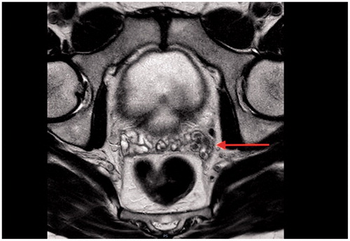 Figure 2. The MRI revealed multiple calculi in the left seminal vesicle.