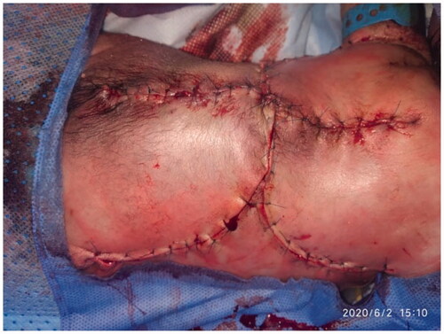 Figure 4. Appearance of the repair at the end of surgery.