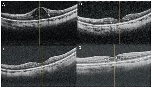 Figure 6 Radial OCT images of eye no.5 in group II ((A) At presentation, (B) 1 month after injection, (C) 3 months after injection, (D) 6 months after injection).