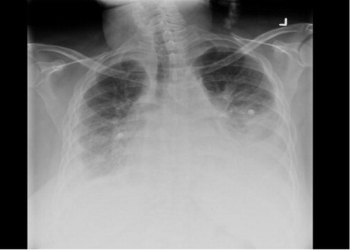 Fig. 1 Chest X-ray during admission showing bi-basilar effusion, atelectasis, infiltrate, and cardiomegaly.