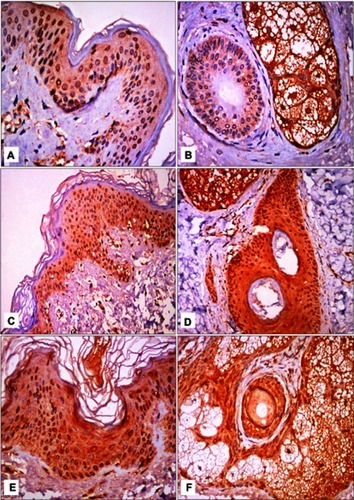 Figure 2 STAT3 immunohistochemical staining.