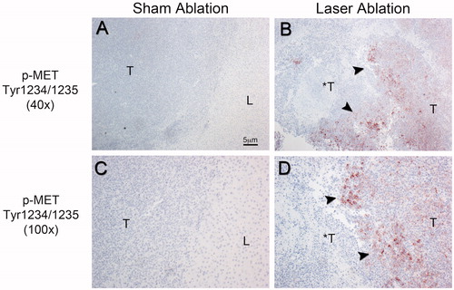 Figure 2. Representative phospho-MET immunohistochemical staining of the ablation zone 24-h post-ablation in the orthotopic N1S1 HCC model. Low power (40×; A,B) and high power (100×; C,D) photomicrographs of phospho-MET immunostained sections. (A,C) Sham ablated tumour. No evidence of MET phosphorylation in the tumour (T), background liver (L) or at the tumour-liver margin in the sham-ablated tumour. (B,D) Laser ablated tumour. Markedly increased MET phosphorylation at the tumour-ablation margin (black arrowheads) in the laser-ablated tumour (*T) with decreased MET phosphorylation further from the ablation margin toward the non-ablated tumour (T). T: non-ablated tumour; *T: ablated tumour; L: normal background liver.