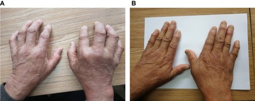 Figure 6 A 68 year-male was diagnosed with RA in 1998. In 2010, he was admitted to our hospital for the first time. (A) Shows that his hands could not be kept straight. (B) After 3 years posttreatment, he has stopped using anti-rheumatism medicine for 5 years, and his hands stretch freely and the rheumatic nodules around the joints gradually become soft and fade.