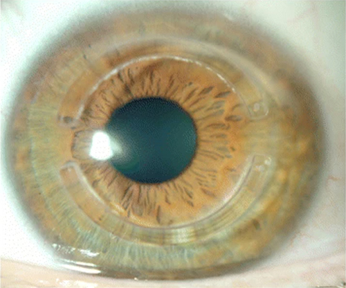 Figure 3 Intracorneal ring segments implanted within the cornea.