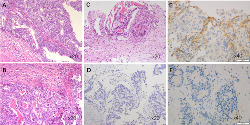 Figure 1 Histologic features of AFPGC and HAS. (A) HE staining of primary lesion of HAS. (B) HE staining of metastatic lesion of the same HAS patient as (A). (C) HE staining of AFPGC sample without typical HAS. (D) Immunohistochemical staining for AFP (negative) of AFPGC sample without typical HAS. (E) PD-L1 positive sample by immunohistochemical staining with SP263. (F) PD-L1 negative sample by immunohistochemical staining with SP263.