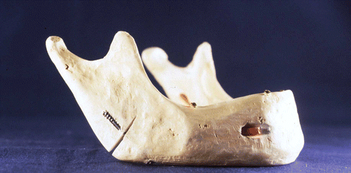 Figure 9. Mandibular model with the inserted bone screw. A perforation of the outer cortical layer can be seen. [Color version available online.]