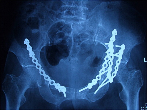 Figure 5. The anteroposterior radiograph one month after surgery shows good reduction and fixation.