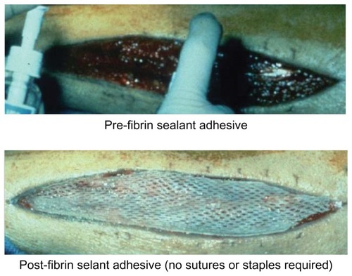 Figure 2 Placement of a split thickness skin graft using a thin layer of fibrin sealant application (top portion) without the need for staples or sutures (bottom portion).