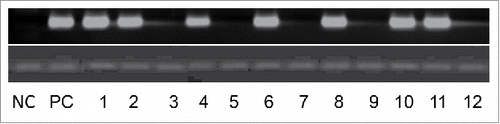 Figure 3. Representative PCR reactions for LMP1 of EBV in 12 colorectal cancer samples. Human normal colorectal cells were used as negative control (NC); and chronic B leukemia cells were used as positive control (PC).