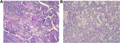 Figure 4 (A) Low power view (40x) from the right ovary showing predominantly follicular growth pattern. (B) Medium power view (200x) from the right ovary showing predominantly follicular growth pattern.