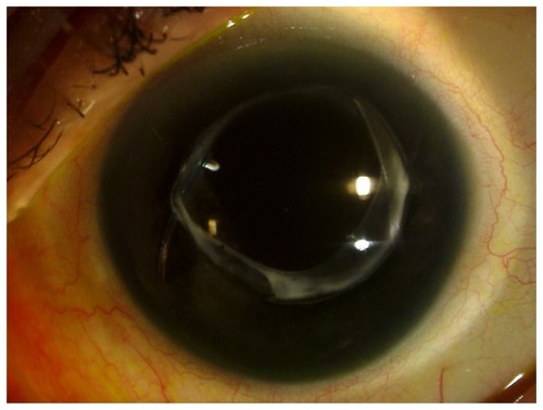 Figure 2 Slit lamp photograph of the left eye.