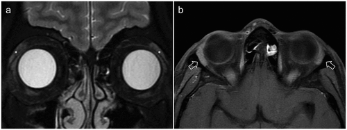 Figure 7. A & B. MRI orbit of 65-year-old female with no ocular disease shows well-defined hyperintense lacrimal gland on coronal T2 fat-saturatedd sequence (A) and axial T1 image (B) acquired using 3 T MRI.