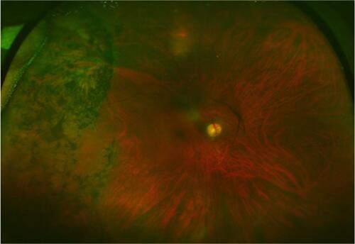 Figure 2 Case 2: 10-year follow-up of temporal rhegmatogenous retinal detachment treated with demarcation-laser photocoagulation.