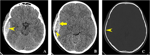 Figure 4 Axial NECT of an 8 years 8 months old girl who hit her head on the concrete while riding a scooter. Right temporo-parietal EDH. (A) Axial NECT brain window shows lenticular hyperdense collection in the right temporo-parietal region - epidural haematoma (yellow pointed arrow). (B) Red arrow shows EDH which is hyperdense because of the clotted blood; yellow pointed arrow indicates hypodense area inside the haematoma suggesting active bleeding (“swirl sign”).Citation4,Citation27 The density of fresh blood is lower than the clotted blood’s one. (C) yellow pointed arrow Axial NECT bone window shows temporo-parietal linear fracture associated with the EHD.
