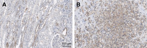 Figure 2 CAV2 expression was detected by immunohistochemistry (IHC).
