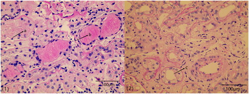 Figure 1. Renal biopsy specimen with acute and chronic tubulointerstitial lesions. (1) shows an acute tubulointerstitial lesion, where a indicates tubular epithelial edema and b indicates tubular epithelial necrosis; (2) shows a chronic tubulointerstitial lesion, where c indicates interstitial fibrosis. (1) and (2) are both Periodic acid Schiff (PAS) staining ×400.