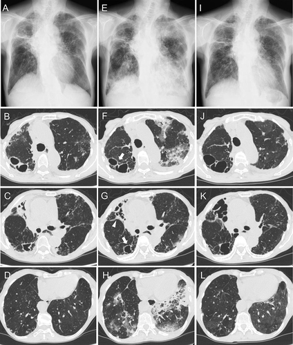Figure 1 Chest X-ray and computed tomography of the upper, middle, and lower lungs, before the start of amikacin liposome inhalation suspension (ALIS) therapy (A–D), 3 weeks after ALIS initiation (E–H), and 9 weeks after the withdrawal of ALIS (I–L). Cavity wall (arrows) and bronchial wall (arrowhead) thinning was observed 3 weeks after starting ALIS treatment.