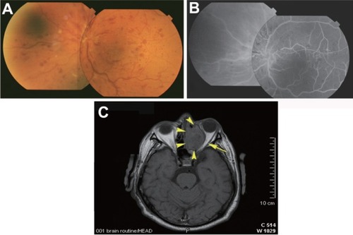 Figure 2 Fundus photographs, fluorescein angiograms, and cerebral MRI of Case 2 obtained in 2008. (A) Central retinal vein occlusion can be seen in left eye: hyperemic swollen papilla, engorged veins, streaky retinal bleedings, and cottonwool spots. (B) Fluorescein angiograms showing staining of the walls of large veins, and no nonperfused areas in the left eye. (C) Cerebral MRI shows the tumor in paranasal sinuses (arrow heads), compressed optic nerve (arrow), and proptosis of the left eye.