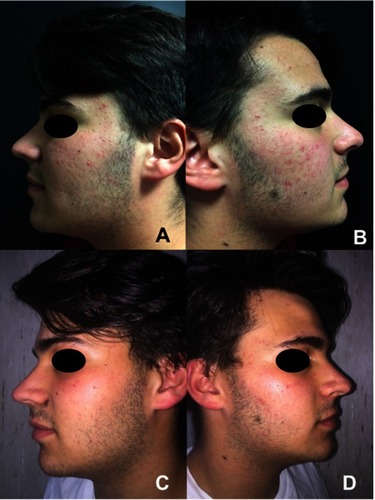 Figure 1 Efficacy of the treatment. Clinical evaluation before (A and B) and after 12 weeks of treatment (C and D) .The mean GAGS score decreased significantly over the course of the study period.