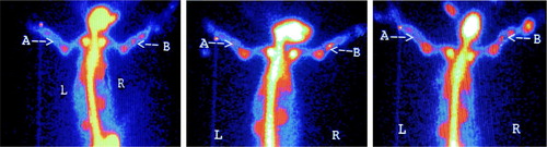 Figure 2. Radionuclide bone imaging photo of control group.