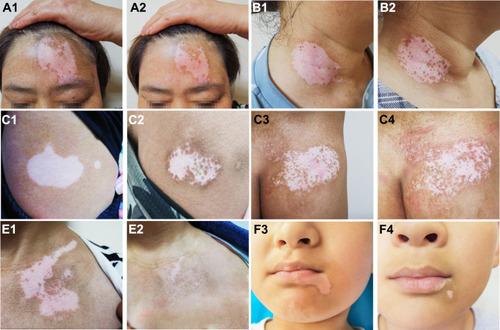Figure 2 Typical examples of repigmentation before and after treatment. a1 and a2: Facial lesions before and after treatment with PRP injection (repigmentation, <25%). b1 and b2: Neck lesions before and after treatment with PRP injection (repigmentation, <25%). c1 and c2: Trunk lesions before and after treatment with 308-nm excimer laser alone (repigmentation, 25–50%). d1 and d2: Trunk lesions before and after treatment with 308-nm excimer laser alone (repigmentation, 25–50%). e1 and e2: Chest lesions before and after combined treatment (repigmentation, >75%). f1 and f2: Facial lesions before and after combined treatment (repigmentation, >75%).