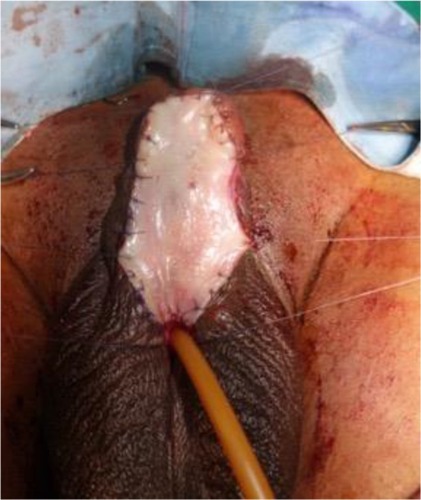 Figure 8 Bracka urethroplasty – insertion of buccal graft.