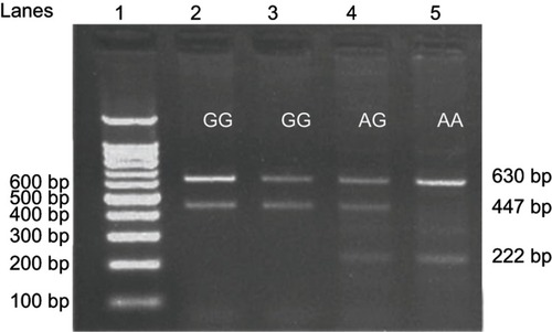 Figure 2 Detection of XRCC1 rs25487 A/G (Arg399Gln) single nucleotide polymorphism using the confronting two-pair primer method (PCR-CTPP).