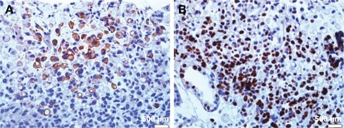 Figure 1 The PIWIL1 protein detected in cytoplasm (A) and in nucleus (B) of the GC cells by immunohistochemical staining. Table 1 Associations between high PIWIL1 expression and clinicopathological characteristics in GC patientsDownload CSVDisplay Table