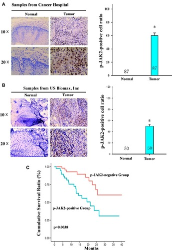 Figure 5 JAK2 kinase was a prognostic factor of ESCC patients treated with chemoradiotherapy. (A and B) A representative result of p-JAK2 expression in primary tumor tissues and in matched normal esophageal epithelial tissues of ESCC patients from Hangzhou Cancer Hospital (n=87) or US biomax, Inc (n=50) by immunohistochemical analysis. The quantitative analysis of p-JAK2-positive cell ratio in tumor tissues and in matched normal esophageal epithelial tissues is shown in the left panel. *P<0.05, compared with p-JAK2-positive cell ratio in matched normal esophageal epithelial tissues. (C) Kaplan–Meier analysis showed an overall survival of those p-JAK2-positive ESCC patients was significantly poorer than those p-JAK2-negative patients treated with chemoradiotherapy. The grading of p-JAK2 expression was described in “Materials and Methods”.