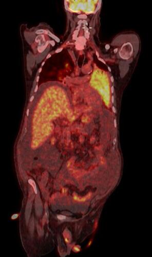 Figure 1 The PET-CT examination shows accumulation of the metabolic tracer of a diffuse character due to pulmonary thickening, with ground glass. Concomitant further accumulation of the tracer is found in some lymph nodes in the intercavo-aortic area, inter-portocaval and hepatic hilum. Limited to the resolution capacity of the method (4 mm) no further pathological areas are highlighted accumulation of the radiopharmaceutical in the remaining areas of the body examined.