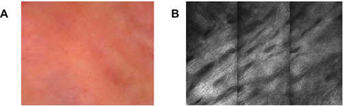 Figure 2 Polarizing dermoscopy and reflectance confocal microscopy examination. (A) Polarizing dermoscopy (PD) examination showed that this lesion had erythematous background with white streaks scattered across the blood vessels, indicating the features of fibrosis; (B) reflectance confocal microscopy (RCM) results revealed that dermal collagen fibers were arranged in dense bundles.